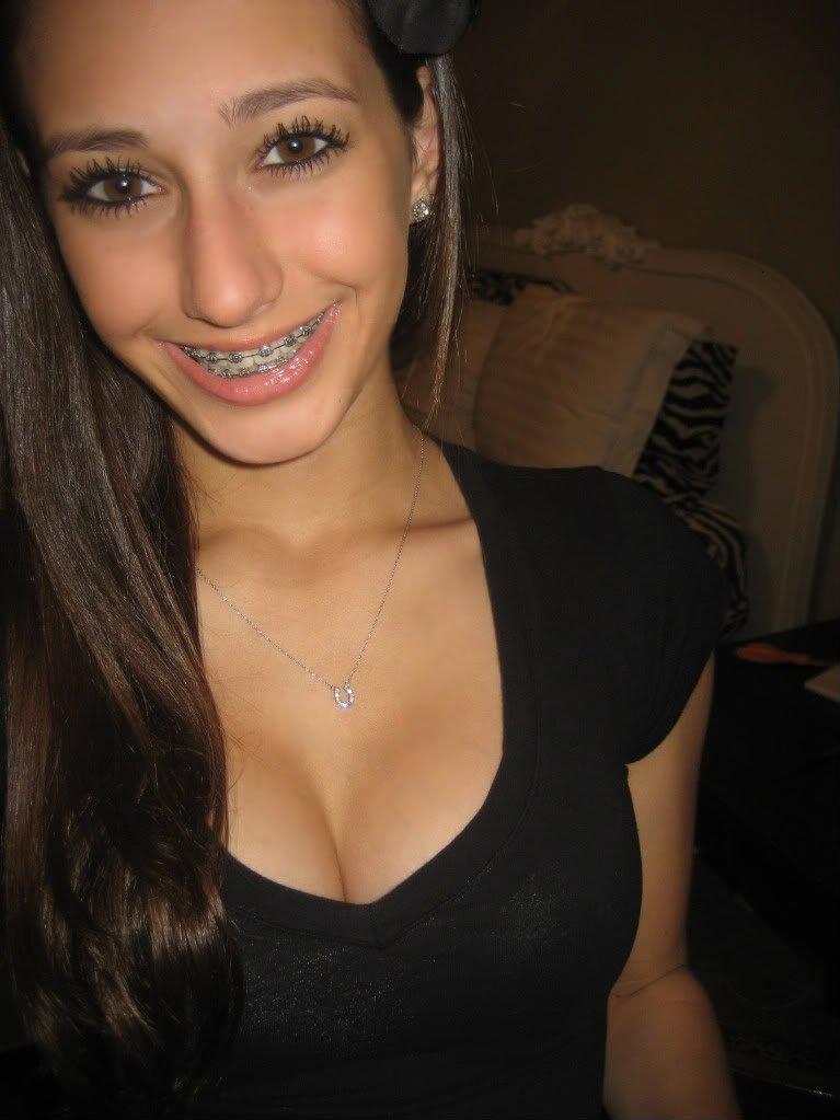 Nude Braces Teen